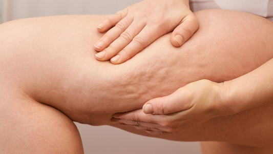 Est-ce que la bromélaïne peut avoir un effet sur la cellulite ?